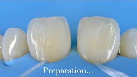 Diastema Closure by resin composite || free hand technique