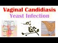 Vaginal Candidiasis (“Yeast Infection”) Causes, Risk Factors, Signs &amp; Symptoms, Diagnosis, Treatment