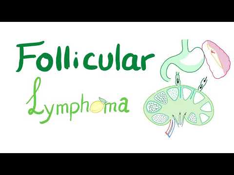 Follicular Lymphoma | Indolent B-Cell Non-Hodgkin’s Lymphoma