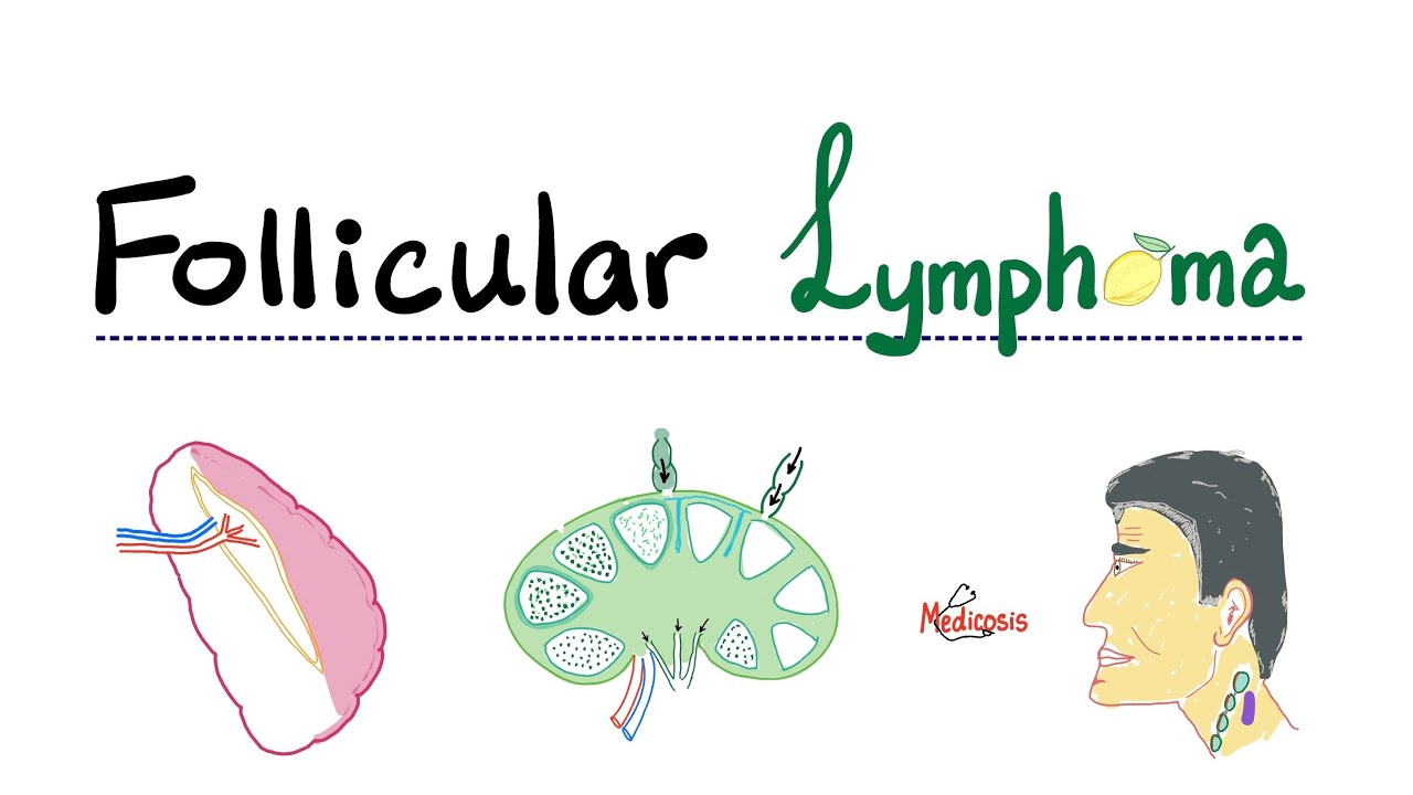 Follicular Lymphoma - Indolent B-Cell Lymphoma - Non-Hodgkin’s Lymphoma - Hematology