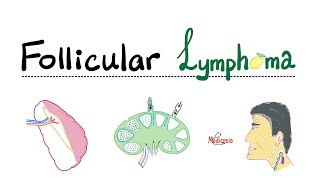 Follicular Lymphoma | Indolent B-Cell Non-Hodgkin’s Lymphoma