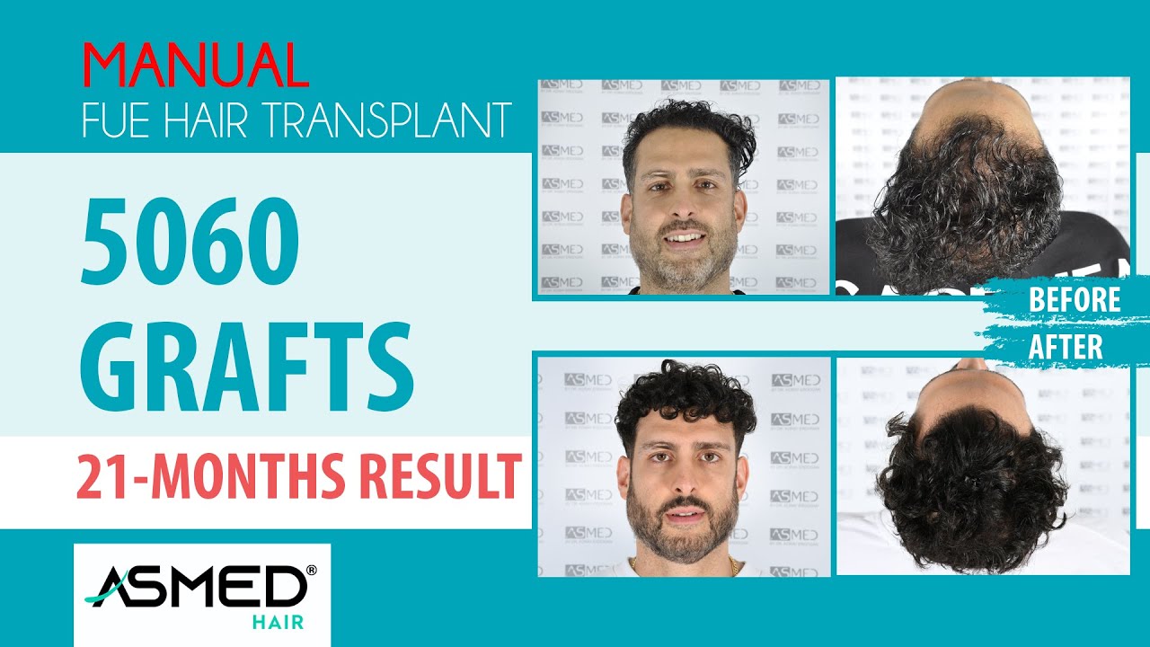 Manual FUE Hair Transplant 5060 Grafts 1 Year 9 Months Result 