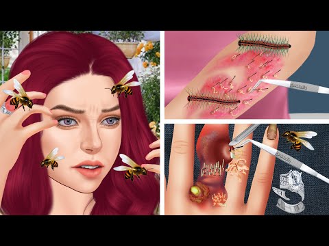 ASMR The best treatment & remove the stinger of the bee stuck in the girl's hand - 핸드 케어 애니메이션 2023