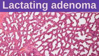 Lactating Adenoma - Pathology mini tutorials