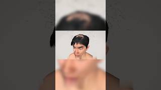 😱"हर दिन बाल झड़ रहे हैं? अब नहीं! असली इलाज जानो!"#HairFallSolution#IndianPharmacy#HairGrowthTips
