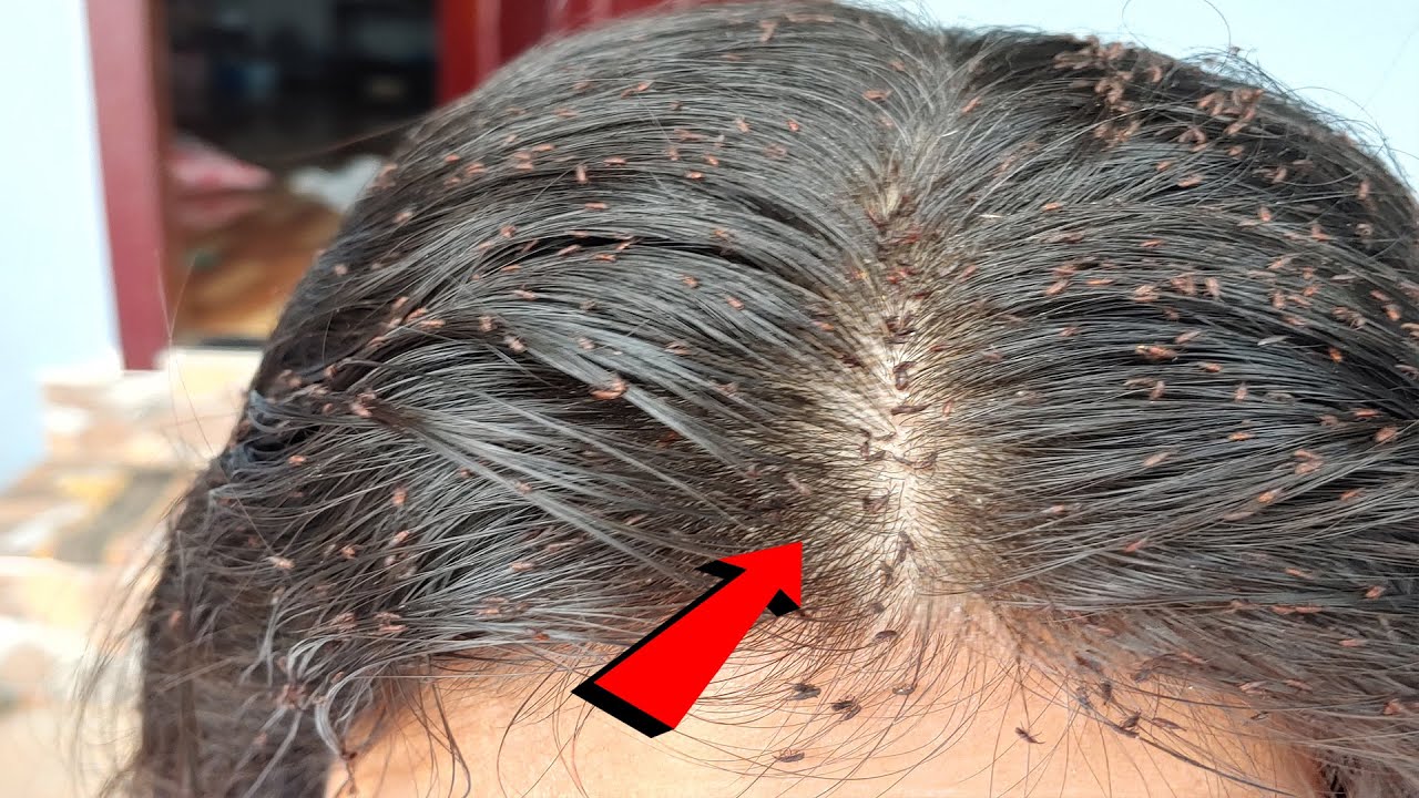 Big Lice removal from this guy's head YouTube