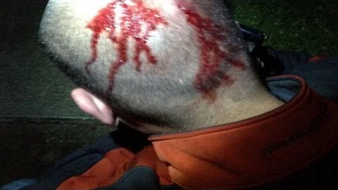Zimmerman Injuries Seen in Exclusive Photo: Pictur...