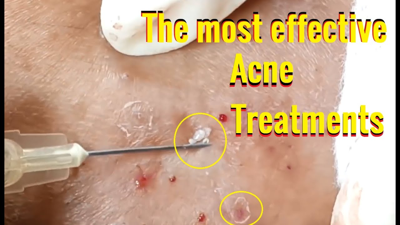 Milia Acne Treatment Blackheads Removal 24 Rid Of Acne YouTube