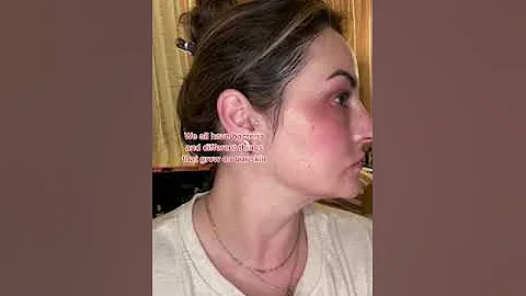 Rosacea Is Caused By WHAT?! 🔬🐛 | Musely FaceRx Rosacea Cream #shorts