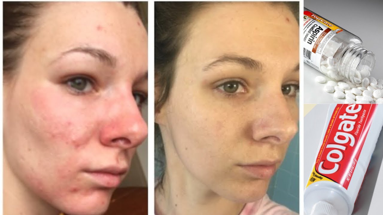 Get Rid of Pimples Overnight | Home Remedy To Get Rid Of Pimple Overnight | Acne Treatment - YouTube