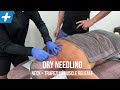 Dry Needling for Neck and Traps Muscle Release | Tim Keeley | Physio REHAB