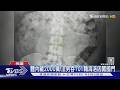 體內藏2000萬! 法男吞101顆海洛因闖國門｜TVBS新聞 @TVBSNEWS01