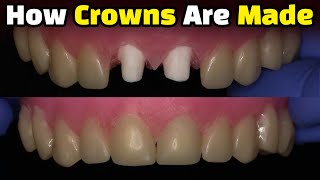 How Dental Crowns Are Made Today