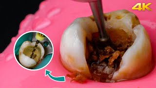 AMAZING Root Canal Treatment Process in 4k!