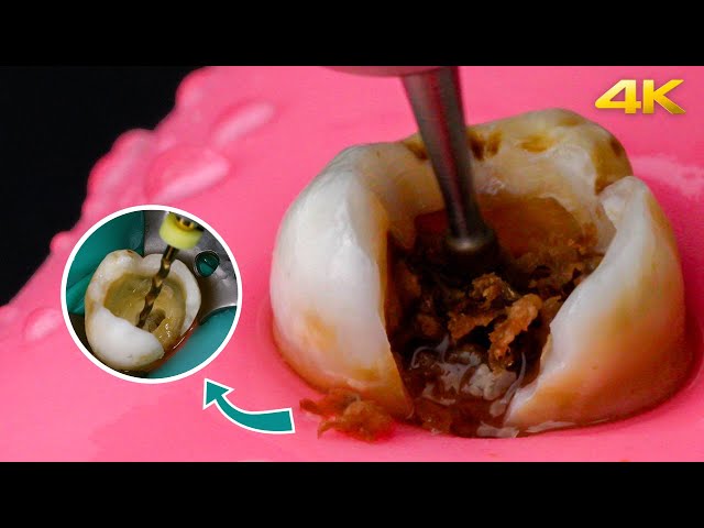 AMAZING Root Canal Treatment Process in 4k! class=