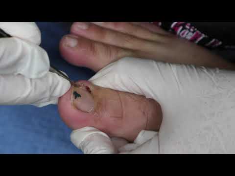 Ep_2951 Ingrown toenail removal 👣 โอ๊ย..โล่งคะ 😷 (This clip is from Thailand)