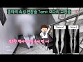 종아리 속성 연장술 7cm +오다리 교정술  완료 환자 영상