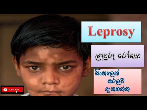 Leprosy/ ලාදුරු රෝගය/ how it happens/ causes/ symptoms/ treatment/ sinhala/ how to prevent