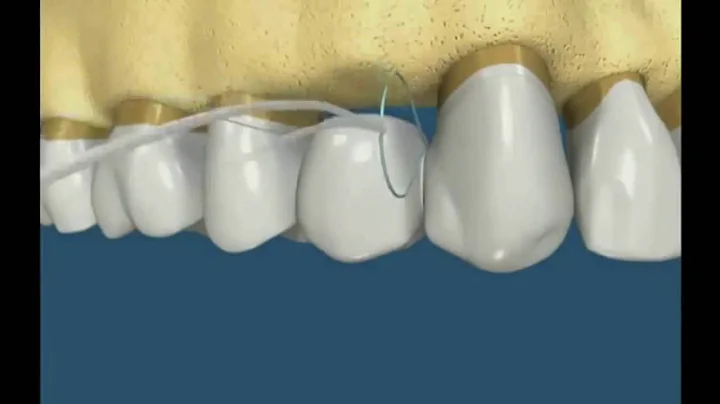 How flossing around a dental bridge..