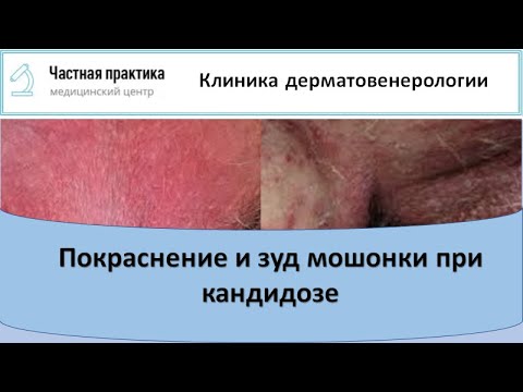 Покраснение и зуд мошонки при кандидозе