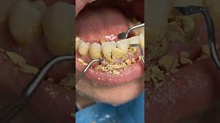 Thick Tartar & Plaque Build-Up Removed! 😱 Satisfying Cleaning 🦷