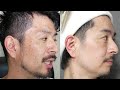 【驚愕】メンズ美容歴４年で肌キレイになりすぎな件