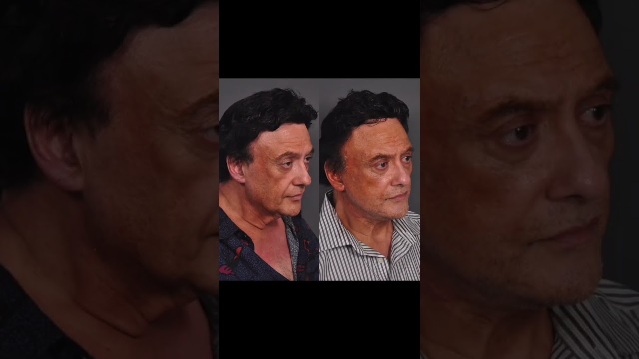Male Facelift Results 
