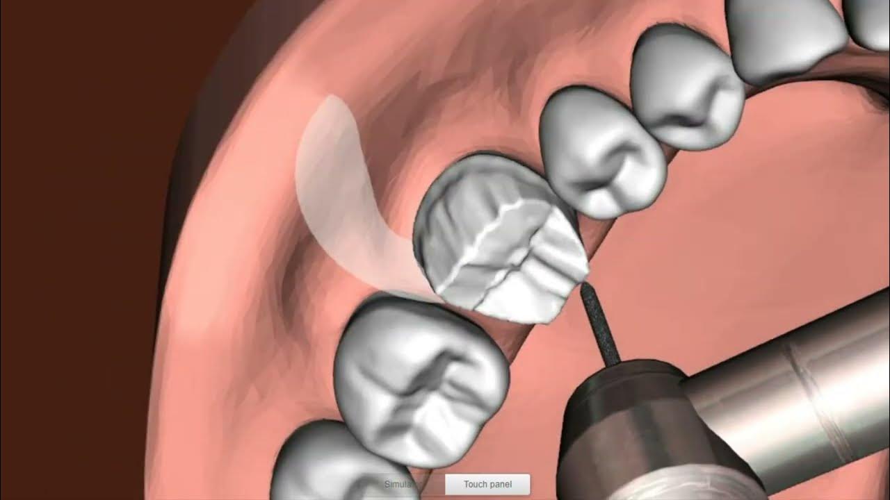36 Chamfer margin preparation demo Simodont Dental Trainer YouTube