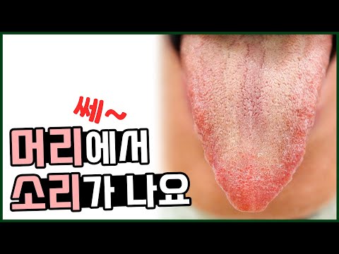 동의보감 뇌명증/ 머리에서 쎄하는 소리가 나고 두통 어지럼증도 있어요