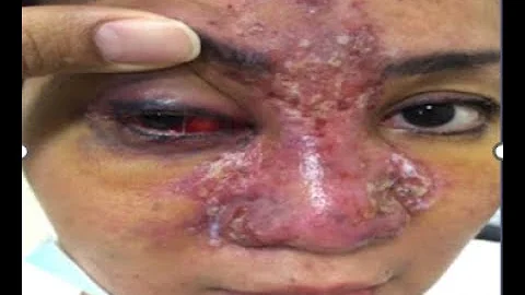 Long Beach VIDEO Ophthalmic Complications of Minim...