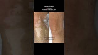 부산 백반증 커버 타투 작업영상 -부산더나인 #부산백반증 #부산백반증타투 #부산백반증커버 #백반증타투 #백반증커버 #백반증치료 #백반증 #백반증문신