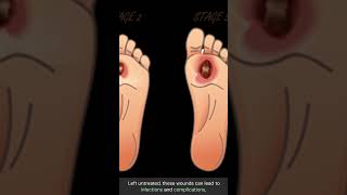 Diabetic Ulcer Warning Signs