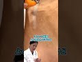【傷痕のレーザー】フラクショナルレーザーによる過激な傷痕治療！色素沈着を招く恐れがあるため注意が必要！