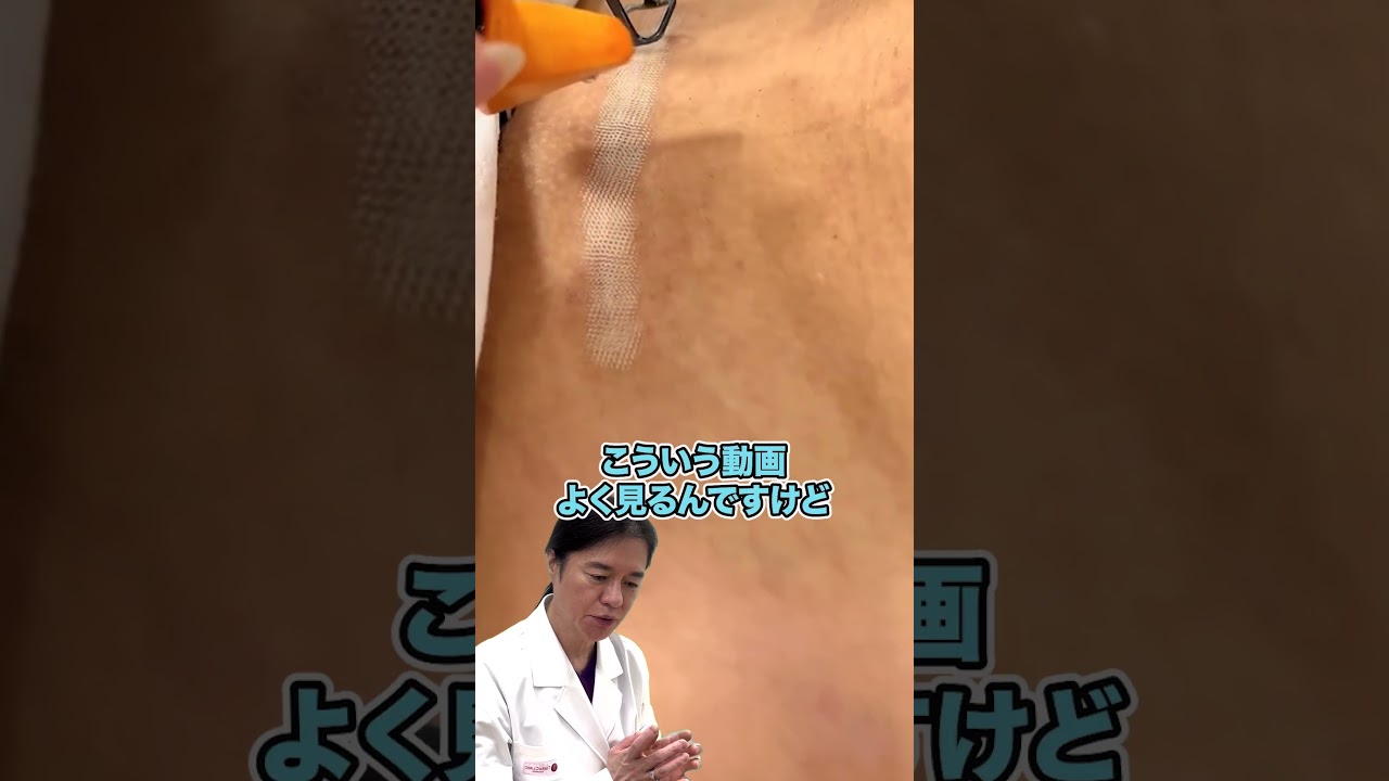 【傷痕のレーザー】フラクショナルレーザーによる過激な傷痕治療！色素沈着を招く恐れがあるため注意が必要！