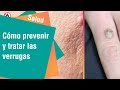 Cómo quitarse una verruga | Salud