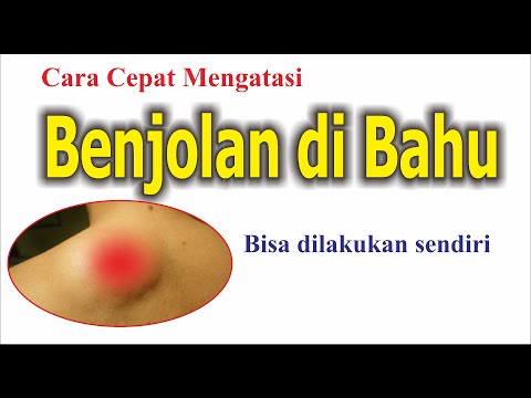 Video: 3 Cara Membunuh Kutu