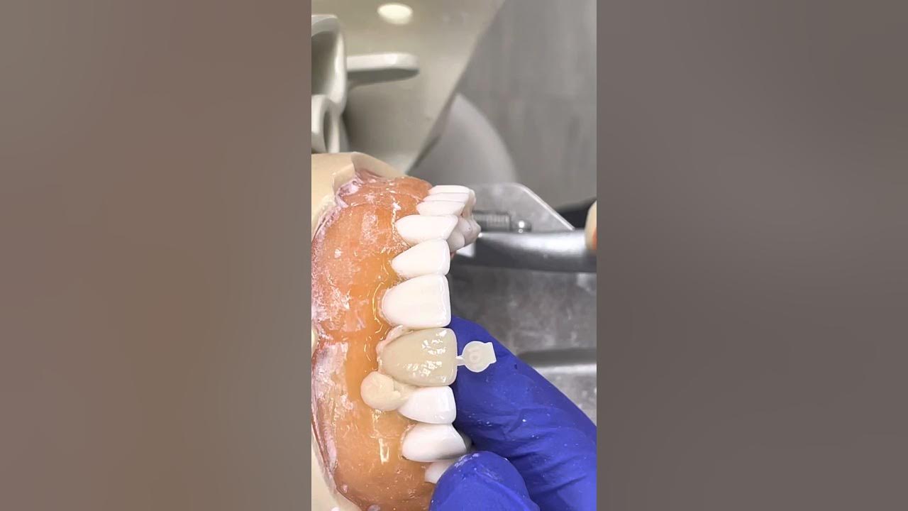 Provisional crown fabrication with polycarbonate crown YouTube