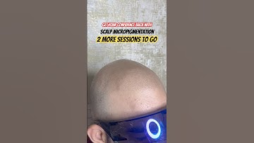 Scalp micro pigmentation - wait for complete transformation #scalpmicropigmentation #scalpdots