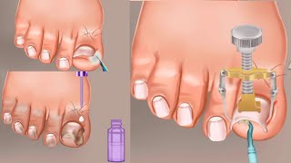 Asmr coolness ingrown toenail removal treatment animation