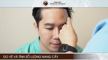 Hình ảnh thực tế | Quy trình cấy tóc tại phòng khám Cấy ghép tóc Y học Quốc tế.