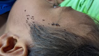 Remove a lot of lice from her long hair - Take out all of big lice from his head