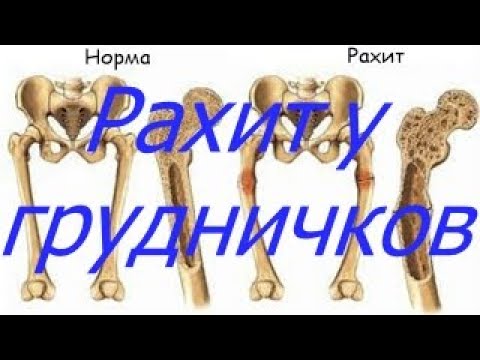 Рахит у грудничков I Мамули и детки