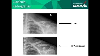 Radiografia de Clavícula : AP   AP Axial (método de Zanca)
