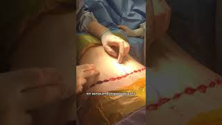 Where Do Belly Ons Go In A Tummy Tuck?