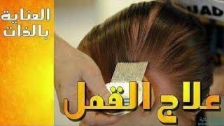 هل تعلم ماهي أسباب ظهور القمل في شعر الأطفال فيديو مهم جدا الك