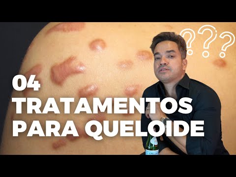 Vídeo: Como impedir o crescimento de um queloide: 10 etapas (com fotos)