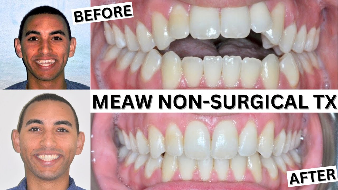 Orthodontics - Multi-Loop Edgewise Archwire (MEAW) MEAW