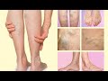 Exercises for varicose veins, exercises to treat varicose veins 10 minutes everyday