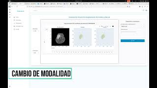 Video demonstration: brain cancer ai support platform - visualization and explanation.