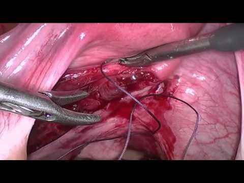 Trapped IUD - YouTube